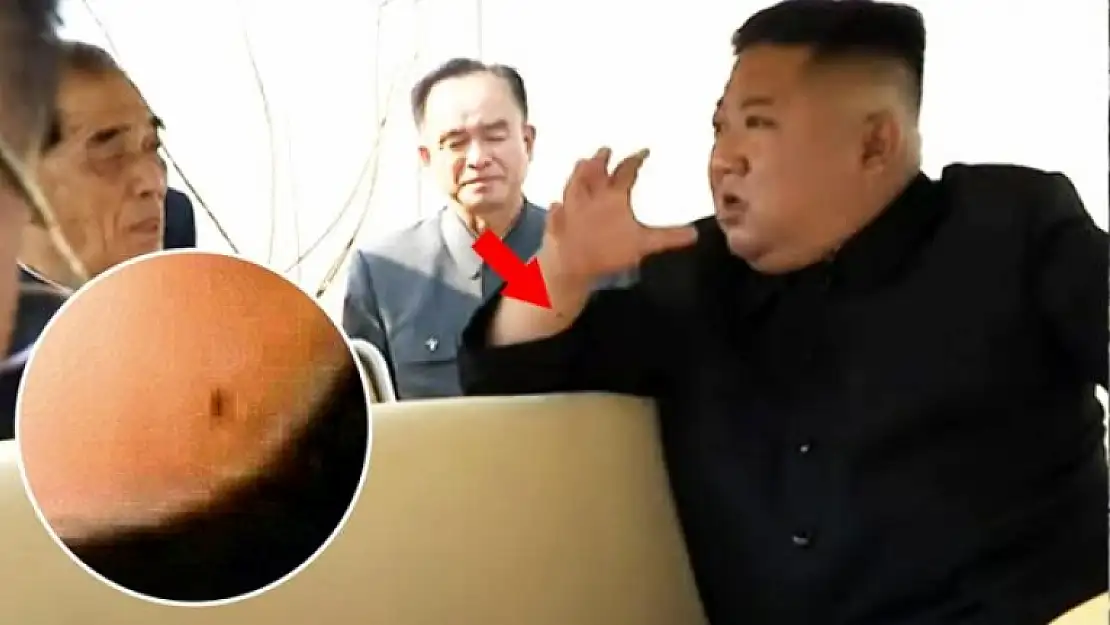 Kuzey Kore Lideri Kim Jong-un Kalp Ameliyatı Olmuş Olabilir!