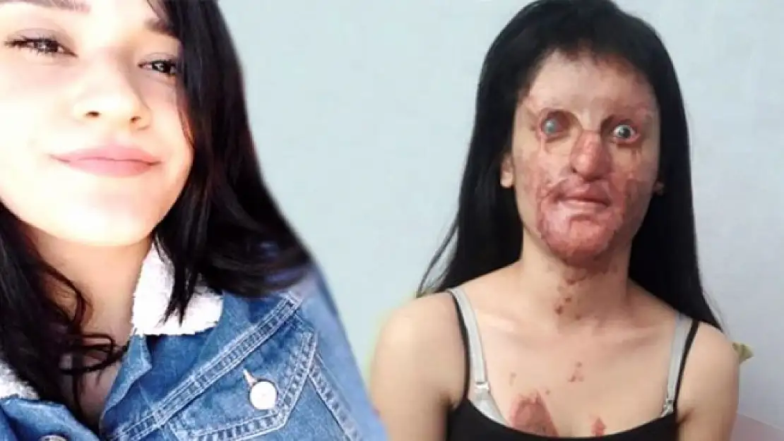 Yüzüne Asit Atan Saldırganı Affeden Berfin Pişman Oldu!