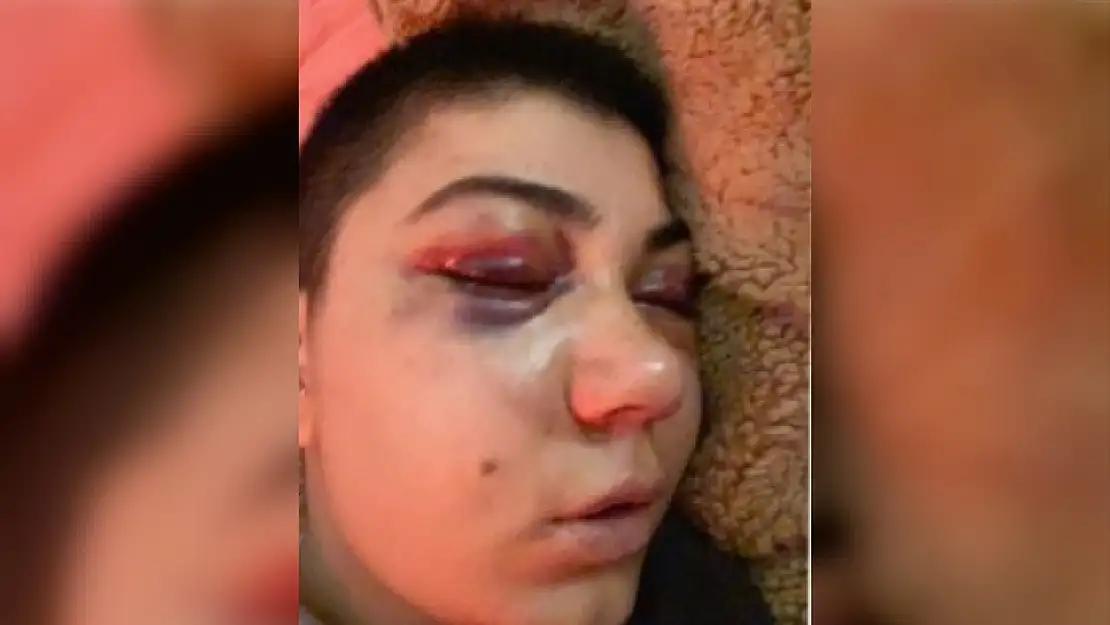 Eğlence Mekânında Şiddet Gören Kadının Yüzü Felç Oldu