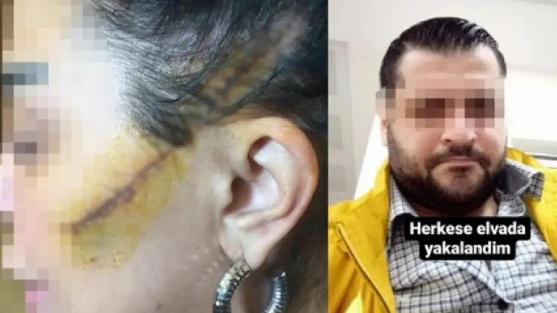Eski Sevgilisinin Yüzünü Kesen Cani Hakkında Flaş Gelişme