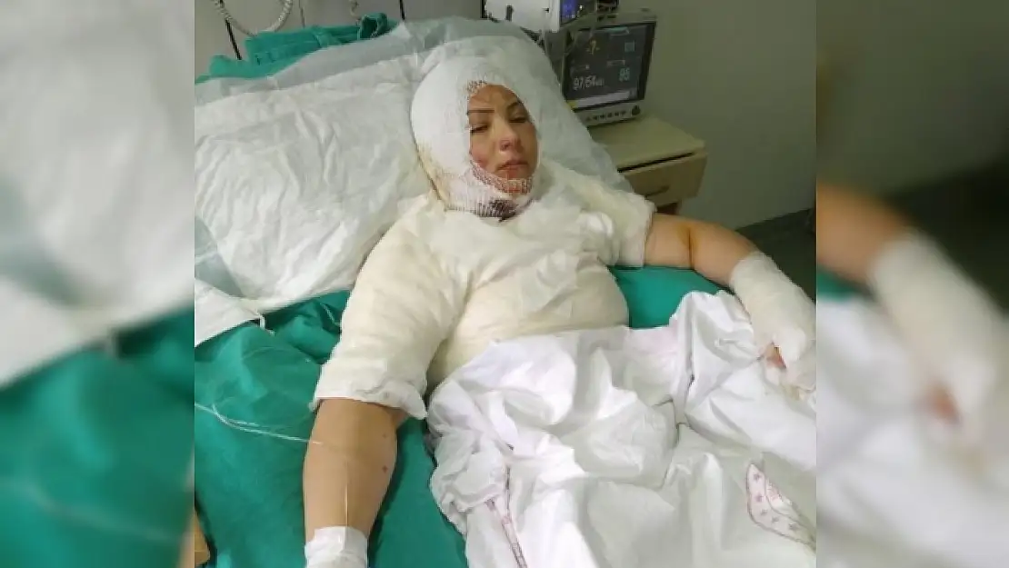 Yanıcı Madde ile Yakılan Kadının Sözleri Yürek Dağladı