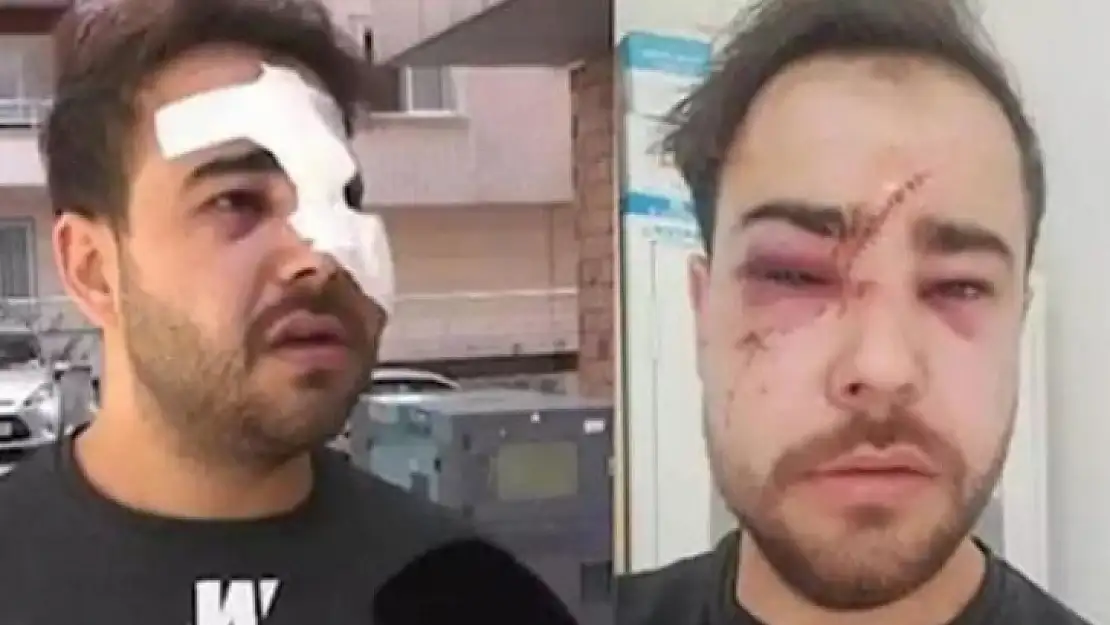 İstek Parçayı Bilmediği İçin Yüzünde Şişe Parçaladılar