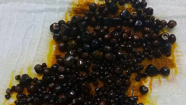 Safra kesesinden rekor sayıda taş çıktı: 491 adet!